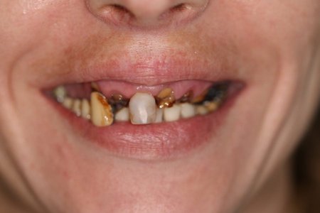 Sonatos dantų būklė prieš operaciją