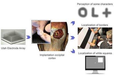 B. Gomez įtaisytas specialus implantas, susidedantis iš 96 mikroelektrodų.. Fernandez et al. 2021 nuotr.