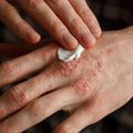 Sergantys šia dažna odos liga gali turėti mažesnį organizmo atsparumą virusams
