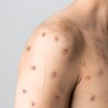 Lithuania to receive 700 monkeypox vaccine doses shortly