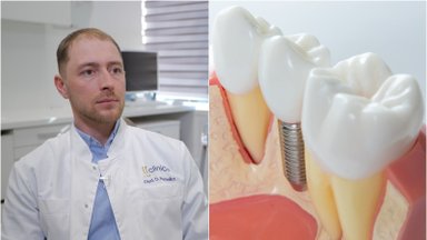Gydytojas atsakė, kiek ilgai tarnauja dantų implantai ir, ar gali jie neprigyti