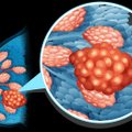 Krūties vėžiu lietuvės serga vis dažniau: onkologės įvardijo, kurioms moterims susirgti – didžiausia tikimybė
