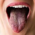 Gydytojas paaiškino, kokias sveikatos bėdas gali rodyti sausumas burnoje