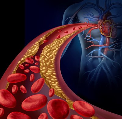 Cholesterolis ir širdies kraujagyslių ribos