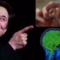 Smegenų implantus sukūrusi Elono Musko bendrovė eksperimentui ieško žmonių: žada sugrąžinti paralyžiuotiems gebėjimą vaikščioti