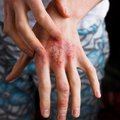 Išvengti neįmanoma: pasakoja, kaip palengvinti bet kam gresiančios odos ligos simptomus