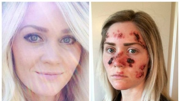 Šokiruojančią merginos nuotrauką pakomentavo dermatologė: kas būna susirgus odos vėžiu