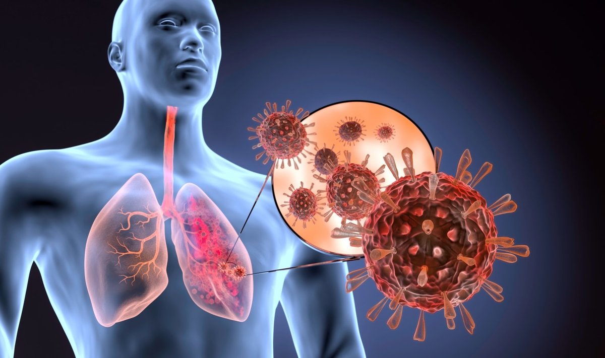 COVID-19 poveikis plaučiams