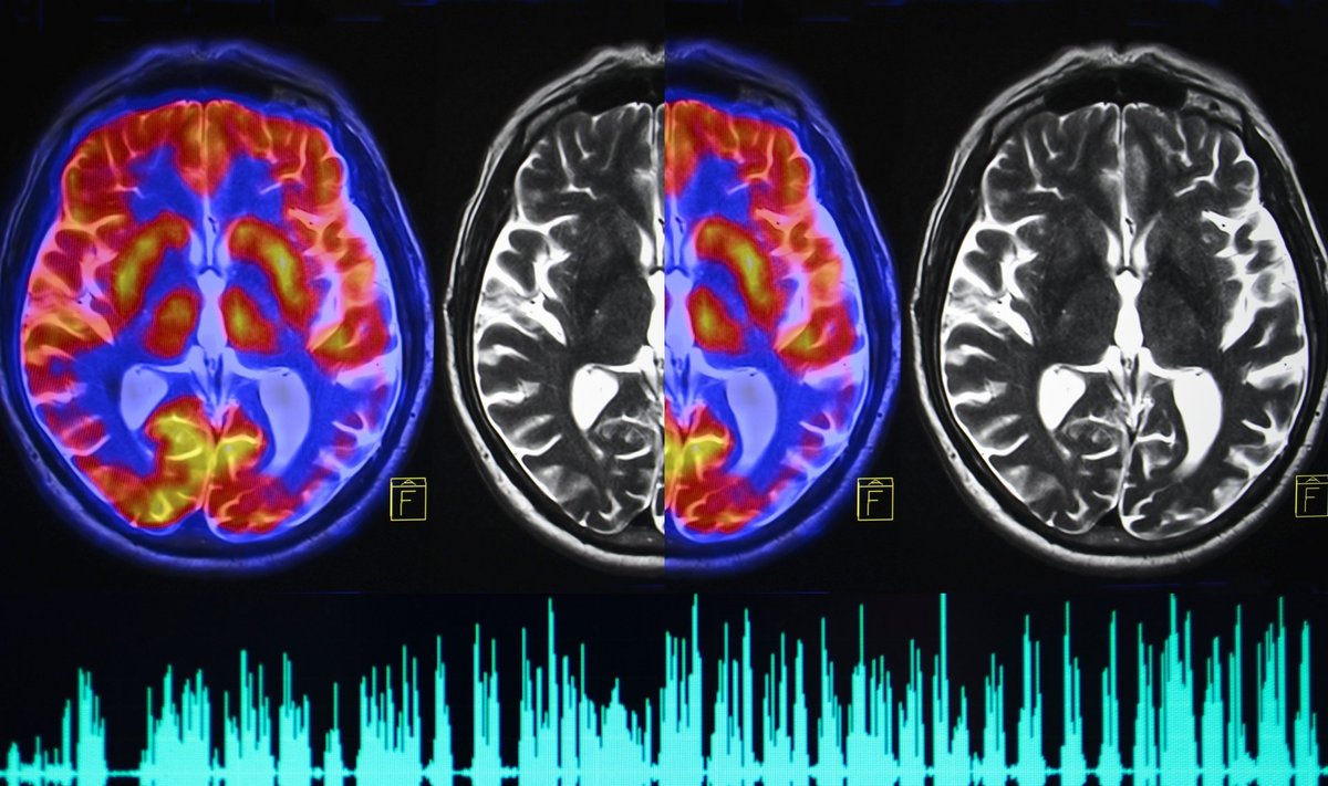 Binauraliniai ritmai gali veikti smegenis kaip įprasti narkotikai.