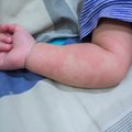 Number of diagnosed measles cases rises to almost 400