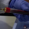 Ispanijos gydymo įstaigose - kraujo tyrimas be adatų