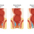 Pirmos stadijos hemorojus: ar galima jį išgydyti?