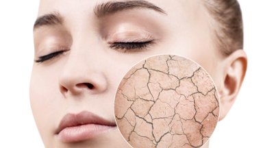 Gripas ir viršutinių kvėpavimo takų infekcijos mūsų odą paverčia problemine: kaip atstatyti skaistumą ir drėgmę