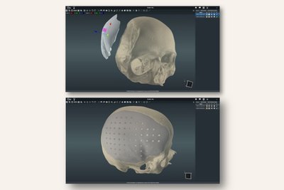 Kranialinių implantų 3D modeliavimas kompiuteriu