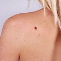 Dermatovenerologė – apie apgamus: kada reikėtų sunerimti ir kaip galime juos pašalinti?