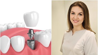 Gydytoja papasakojo, kada protezuoti danties nebegalima: tenka šalinti ir sriegti implantą