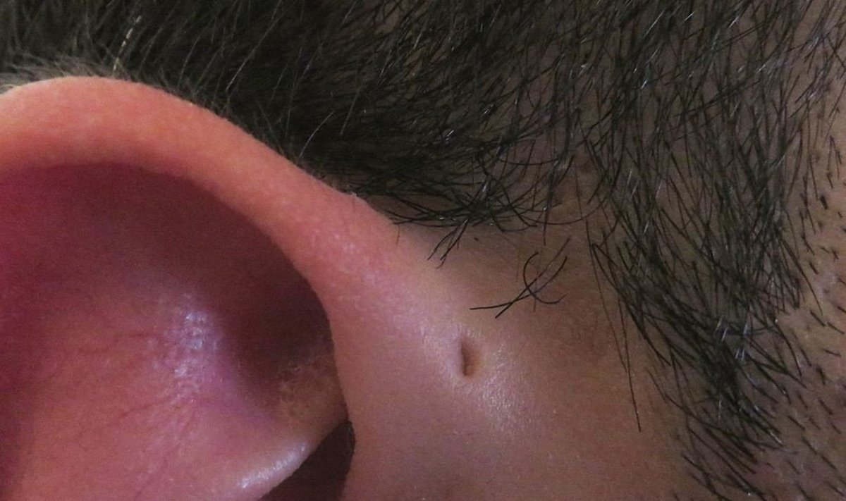  preauricular sinuses