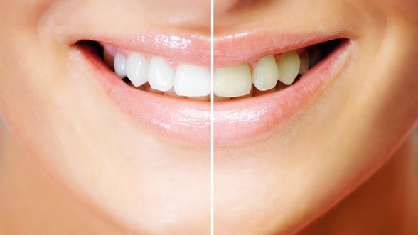 Apie dantų balinimą. Ar saugu? Ar efektyvu? Ką verta žinoti?