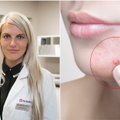 Dermatologė paaiškino, ko jokiais būdais negalima daryti turintiems spuogų