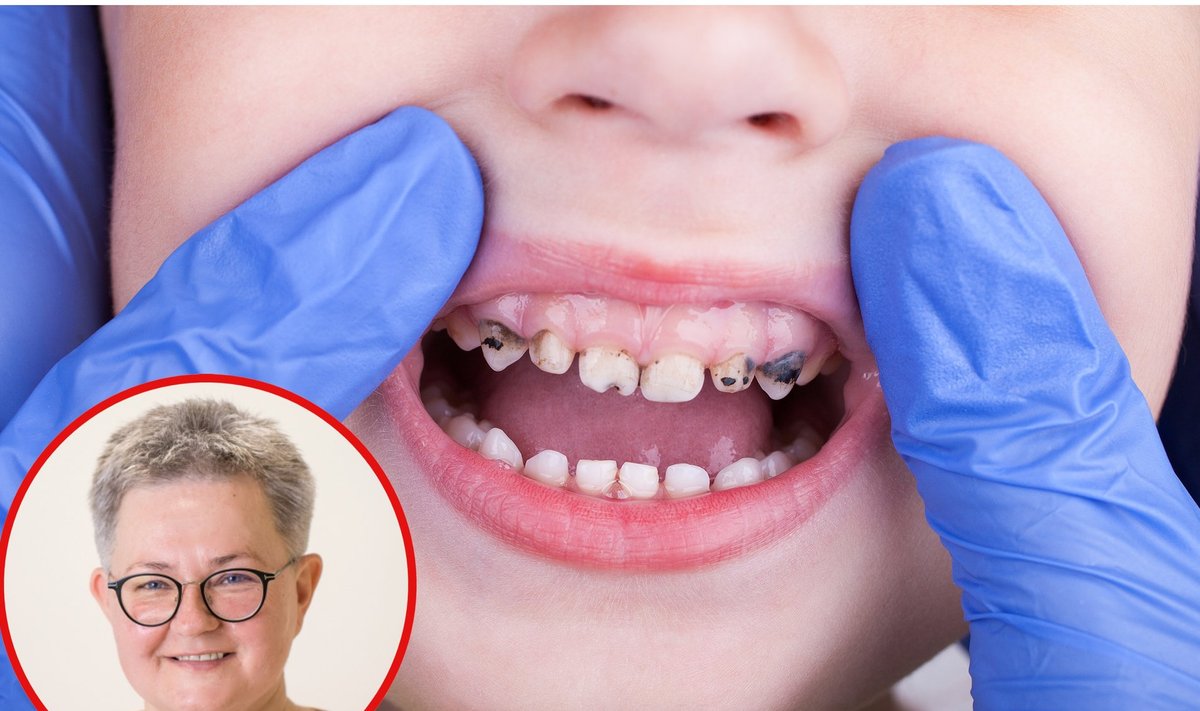 Sugedę vaikų dantys