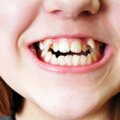 Kreivai sudygę dantys: juos ištiesinti įmanoma ir be breketų