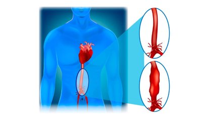 Pilvo aortos aneurizma