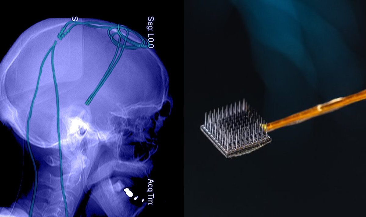 Smegenų implantas. Wyss centre/Shutterstock nuotr.