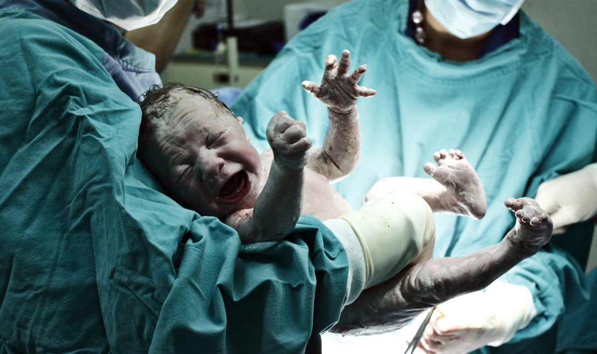 naujagimis, kūdikis, gimdymas, cezario pjūvis, operacija, gydytojas