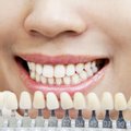 Ką reikėtų žinoti apie dantų balinimą?