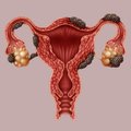 Daugelis endometrioze sergančiųjų to net nežino: kada būtina kreiptis pagalbos?