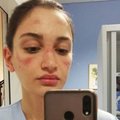 Italijos slaugių kova su koronavirusu: kaukės nubrozdintas veidas, miegas ant darbastalio ir 6 valandos be galimybės nubėgti į tualetą