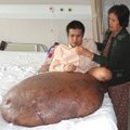 Vietnamiečiui sėkmingai pašalintas 90 kg auglys