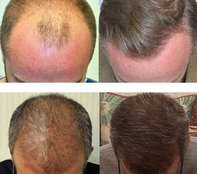 Prieš ir po. DHI metodu persodinami paties paciento plaukai iš donorinės zonos. Rezultatas – natūraliai atrodanti šukuosena. 
