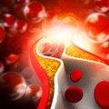 Kardiologė patarė, kaip sumažinti blogąjį cholesterolį: rezultatas pastebimas po poros mėnesių