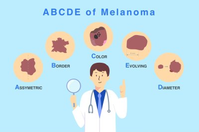 Melanoma