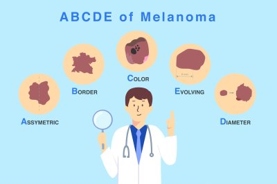 Melanoma