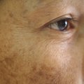 Įvardijo, kada pigmentinės amžiaus dėmės gali signalizuoti odos vėžį, endokrininės sistemos, kepenų veiklos ar kitus sutrikimus