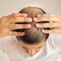 7 būdai sustabdyti plaukų slinkimą