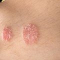 Neišgydoma odos liga gali atsirasti ir dėl nesuderintų vaistų