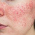 Gydytoja – apie tarp lietuvių dažną odos ligą: išvengti padės kelios taisyklės