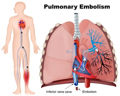 Plaučių trombinė embolija