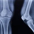 Manė, kad pasitempė raumenis sportuodama: rentgeno nuotrauka parodė tikrąją diagnozę