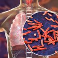 Net 90 proc. žmonių nežino, kad užsikrėtė tuberkulioze: išvardijo, kam rizika susirgti didžiausia