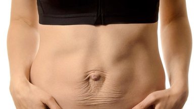 Po gimdymo 35-erių šiaulietė pastebėjo išvaizdos pokytį: paaiškėjo, kad jai – praskyrę tiesieji pilvo raumenys