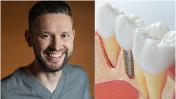 Gydytojas įspėjo, ko nereikėtų daryti netekus danties: gydymas bus sudėtigesnis, brangesnis ir ilgesnis