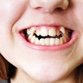 Gydytoja ortodontė: netaisyklingą sąkandį gali nulemti ir netinkamas kvėpavimas