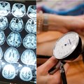 Tyrimas parodė, ką smegenims daro aukštas kraujospūdis: žala pastebima tik sulaukus vidutinio amžiaus