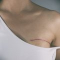 Naujo gyvenimo puslapį moteris atvertė po krūties operacijos