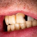 Kiek kainuoja tiesūs dantys?