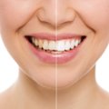 9 gražių dantų paslaptys: žinant jas turėti holivudinę šypseną paprasta